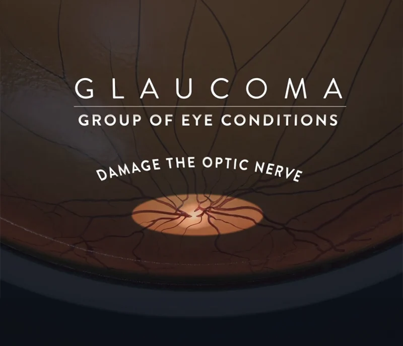 glaucoma damage eye video thumbnail