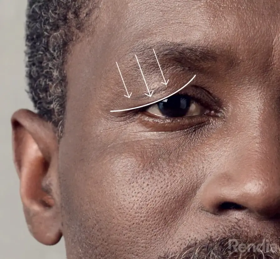 functional eyelid surgery thumbnail