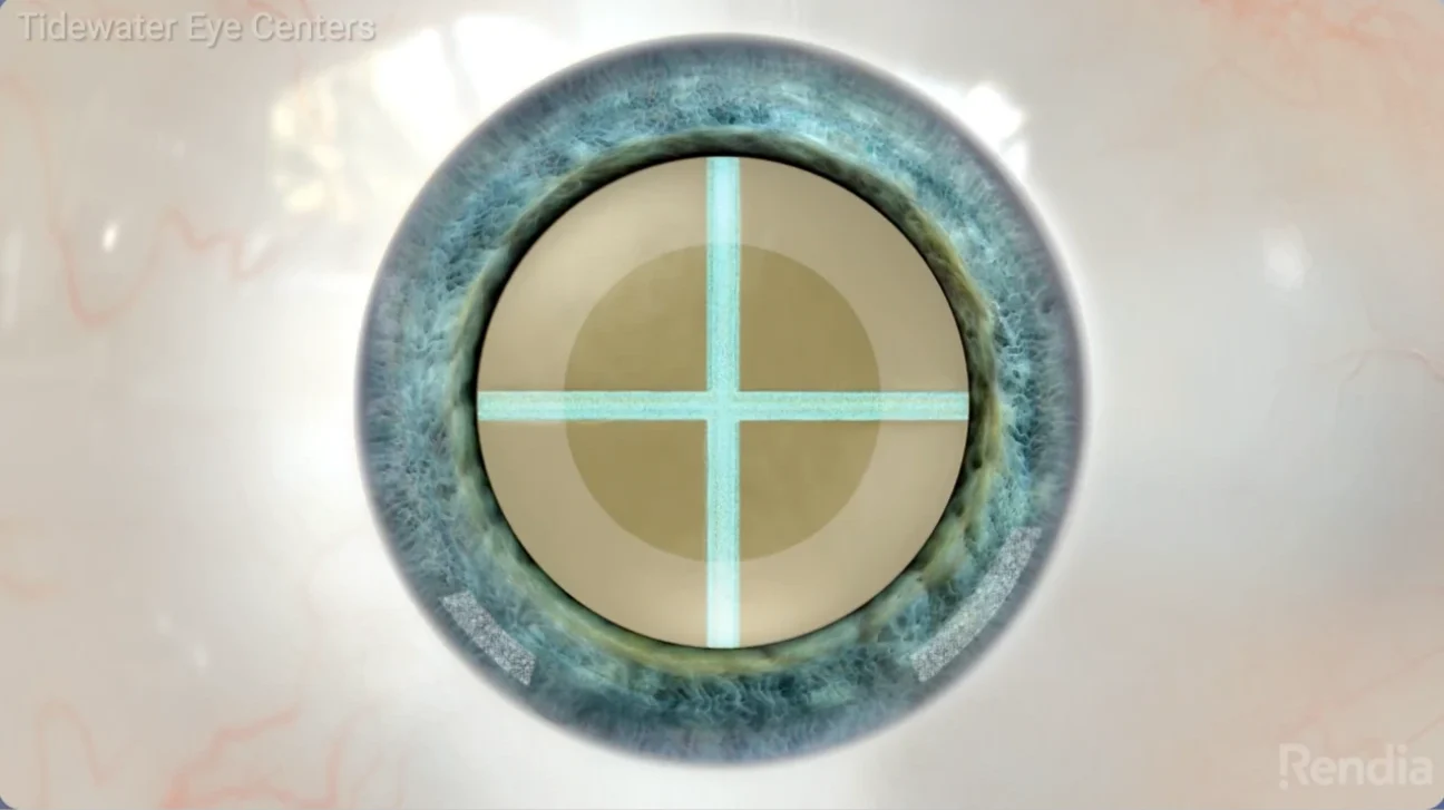 laser cataract surgery video thumbnail