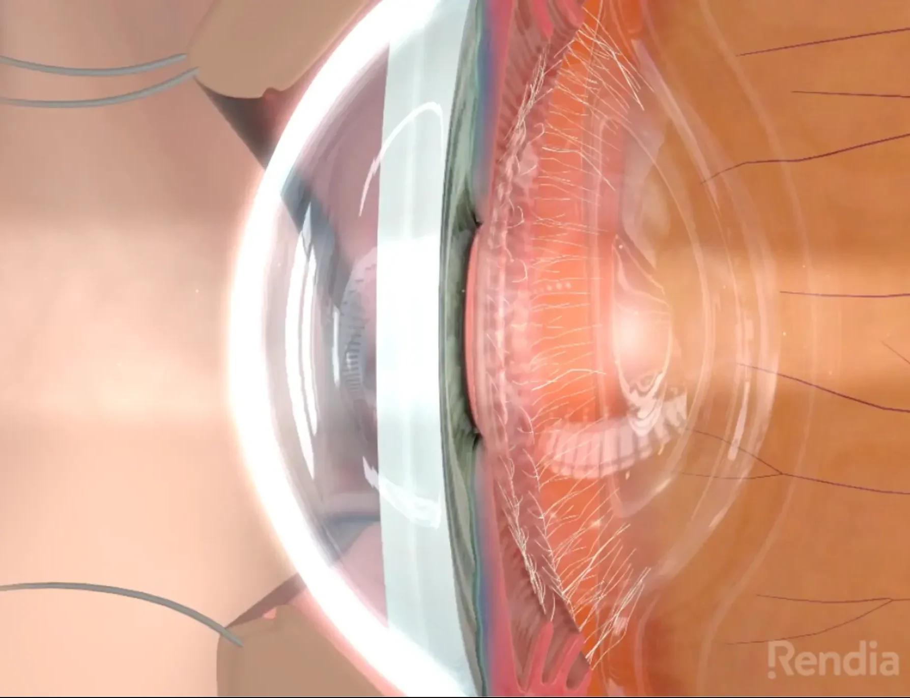 lasik video thumbnail