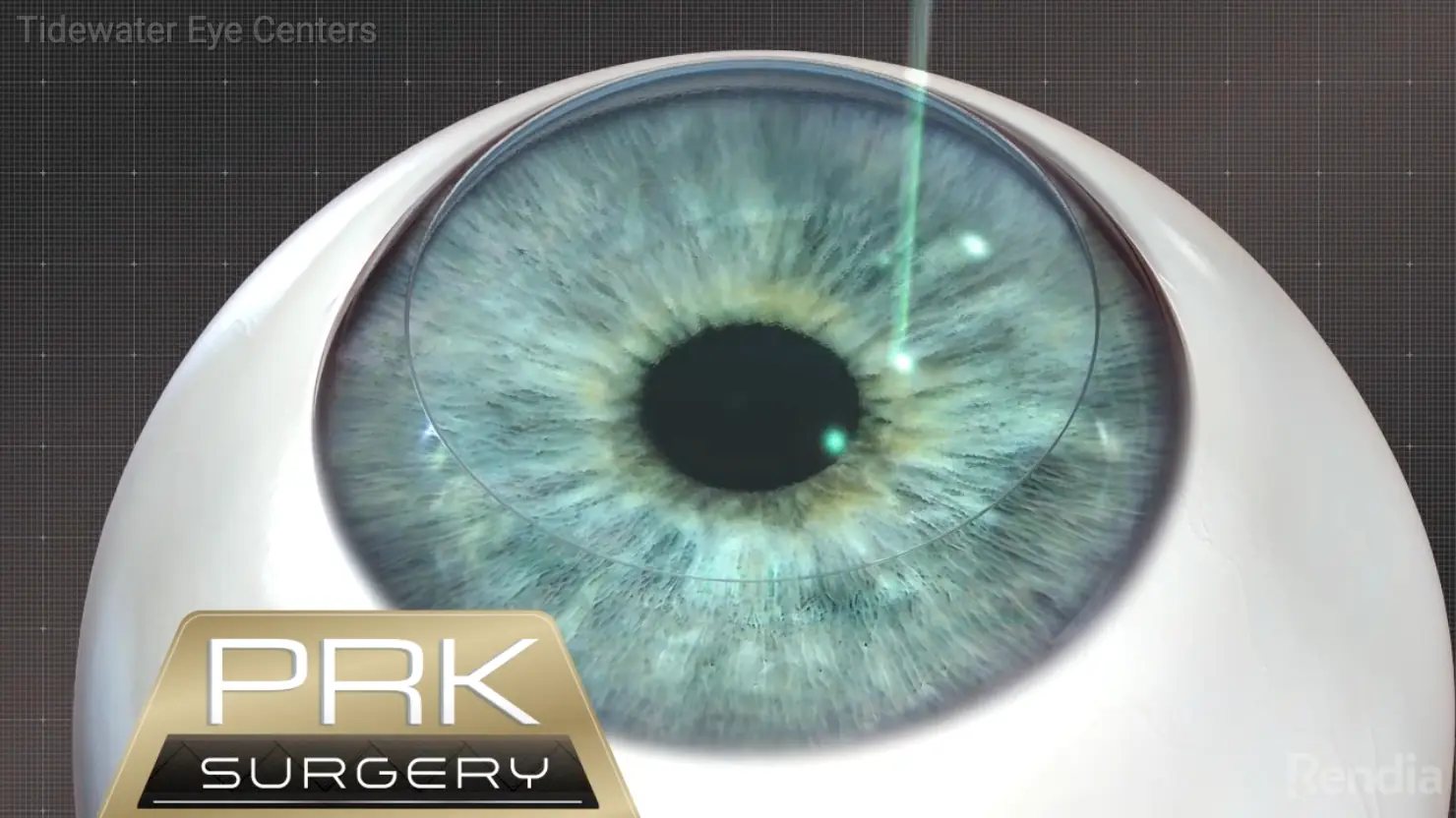 Prk vs. LASIK thumbnail
