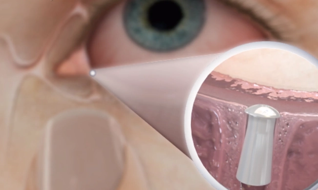 punctal plugs graphic