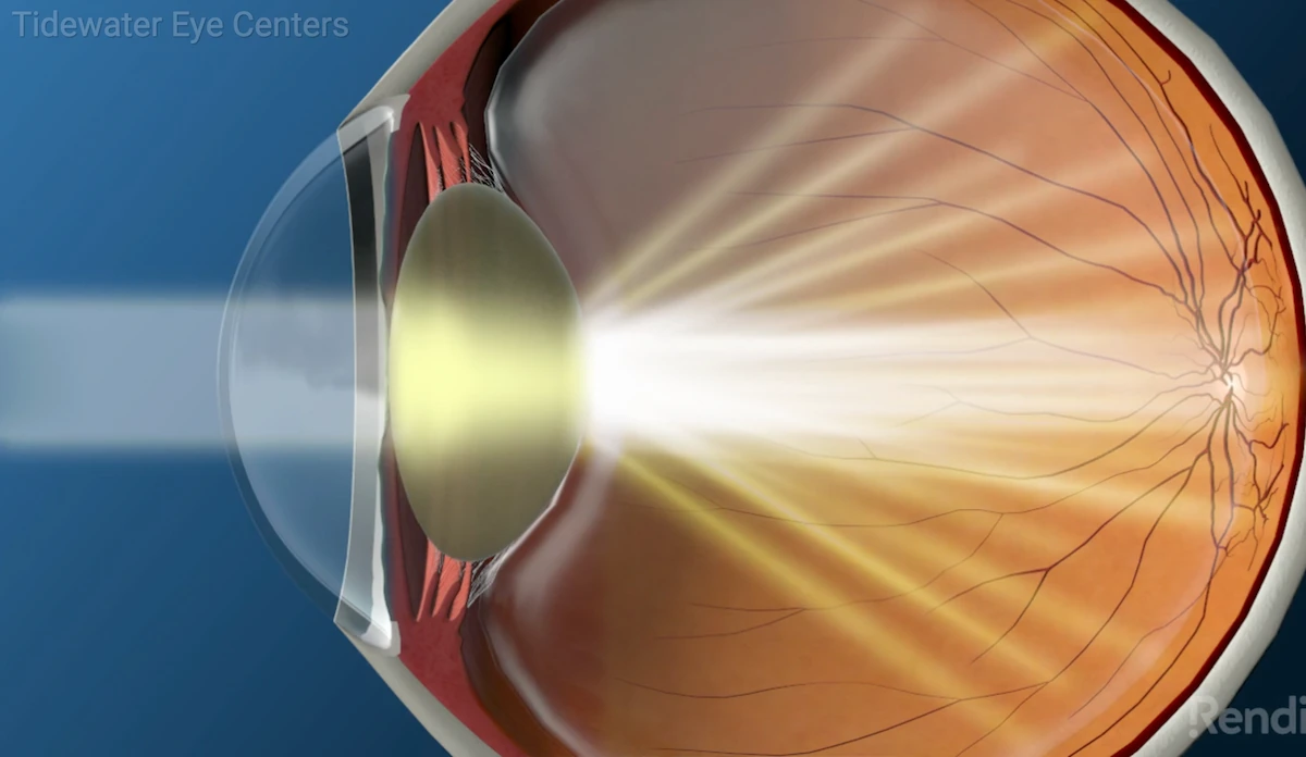 understanding cataracts video thumbnail
